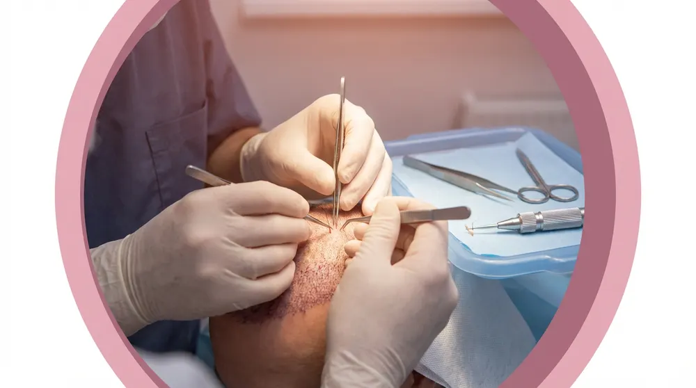 Hair Transplantation